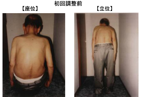 愛知県長久手町　理学整体 鬼頭健康院　椎間板ヘルニア・脊柱管狭窄症