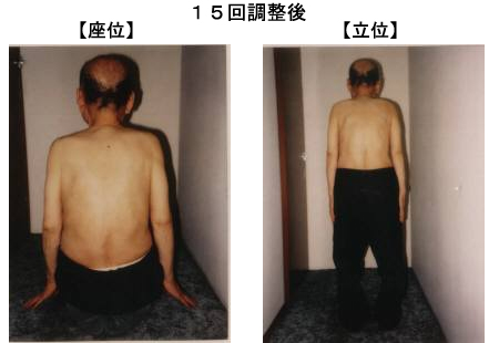 愛知県長久手町　理学整体 鬼頭健康院　椎間板ヘルニア・脊柱管狭窄症