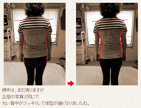 骨盤矯正/体幹矯正/骨盤のゆがみ/ 産後ケア/ 椎間板ヘルニア/脊柱管狭窄症/腰痛/治し方/治療法/整体/鬼頭健康院/長久手市/名古屋市/尾張旭市/日進市