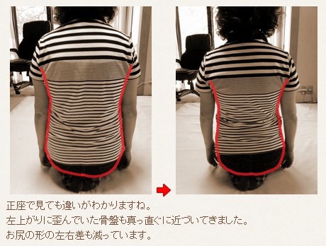 骨盤矯正/体幹矯正/骨盤のゆがみ/ 産後ケア/ 椎間板ヘルニア/脊柱管狭窄症/腰痛/治し方/治療法/整体/鬼頭健康院/長久手市/名古屋市/尾張旭市/日進市